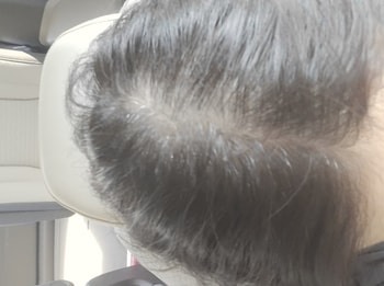 앰플 4번 사용후 두피