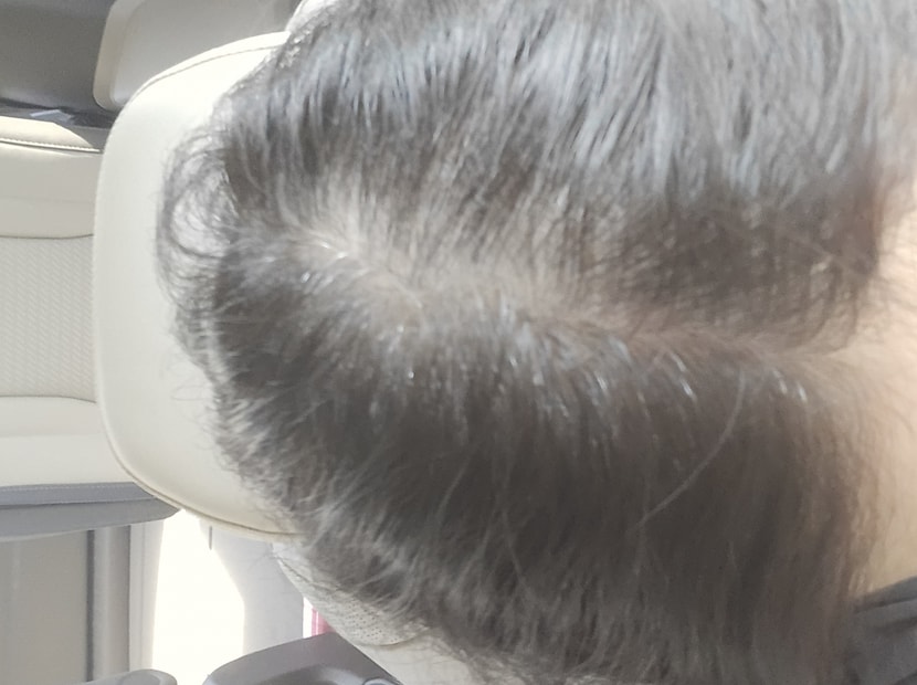 앰플 4번 사용후 두피