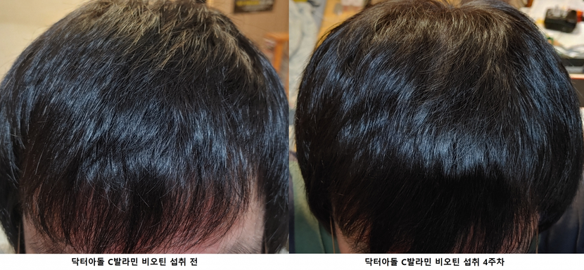 두정부 섭취 전/후 비교사진