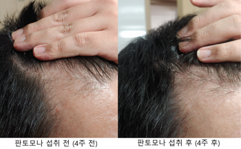 앞라인 M자 오른쪽 비교사진