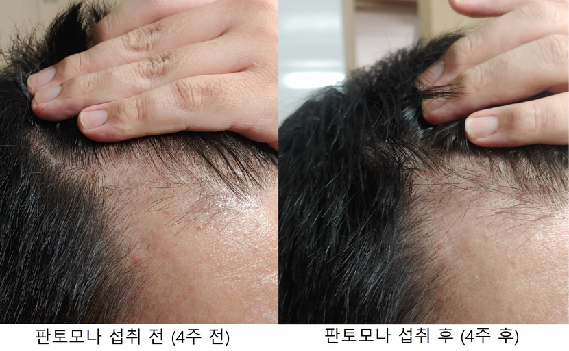 앞라인 M자 오른쪽 비교사진