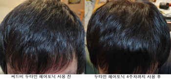 두정부쪽 사용 전/후 사진