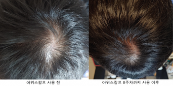 정수리쪽 사용 전/후 사진