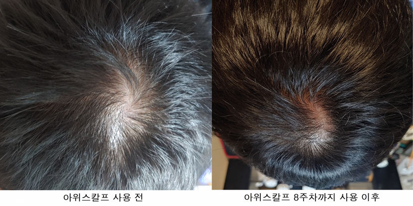 정수리쪽 사용 전/후 사진