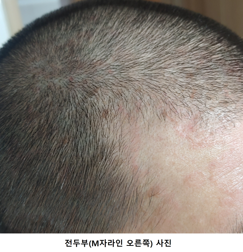 사용 전 전두부(오른쪽) 사진