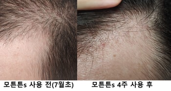 M자 전두부 왼쪽 비교사진