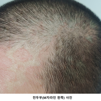 사용 전 전두부(왼쪽) 사진
