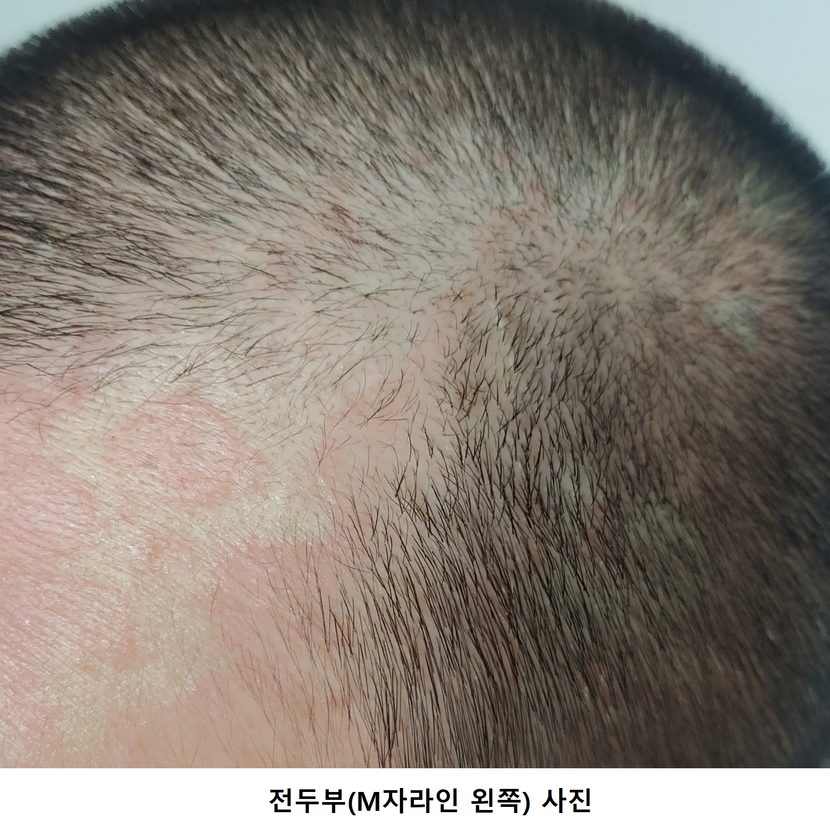 사용 전 전두부(왼쪽) 사진