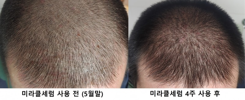 미라클세럼 4주차 마지막 사용후기 (사용 전 비교사진 첨부)