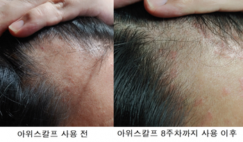 우측라인 사용 전/후 사진