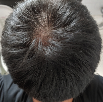두피 뒤쪽 정수리, 뒤통수