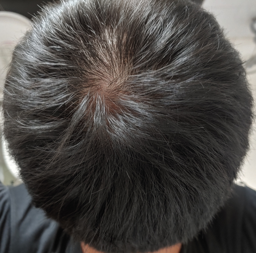 두피 뒤쪽 정수리, 뒤통수