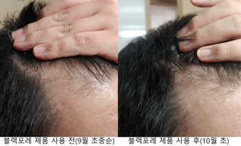 앞라인 M자 오른쪽 비교사진