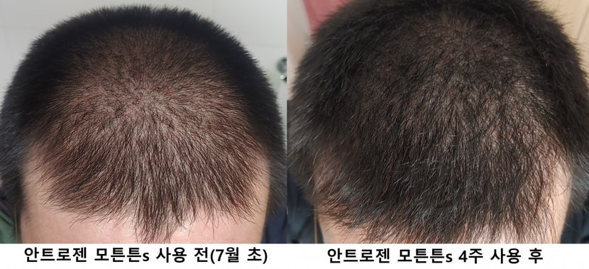 두피위쪽 두정부 사용전후 비교사진