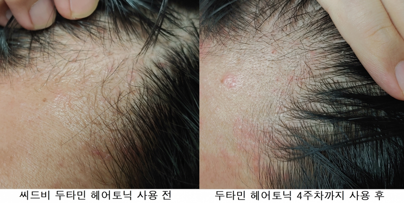 좌측라인 사용 전/후 사진