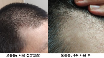 M자 전두부 오른쪽 비교사진