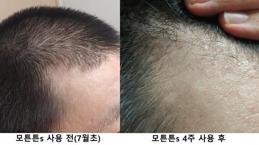 M자 전두부 오른쪽 비교사진