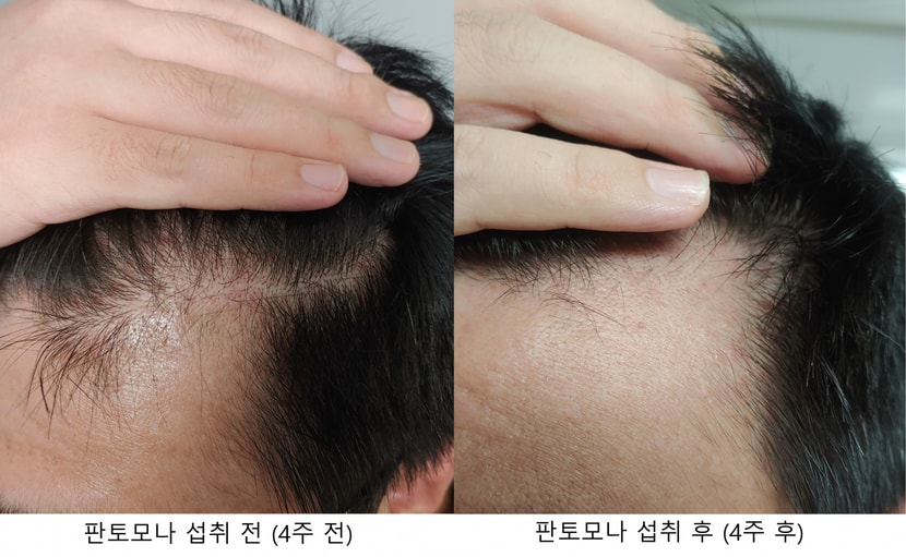 앞라인 M자 왼쪽 비교사진