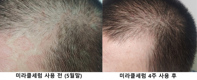 전두부 왼쪽 사용 전후 비교사진