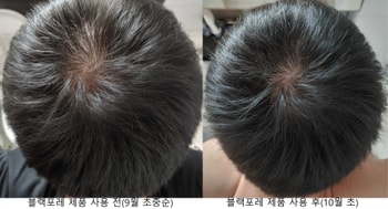 정수리 뒤쪽 비교사진