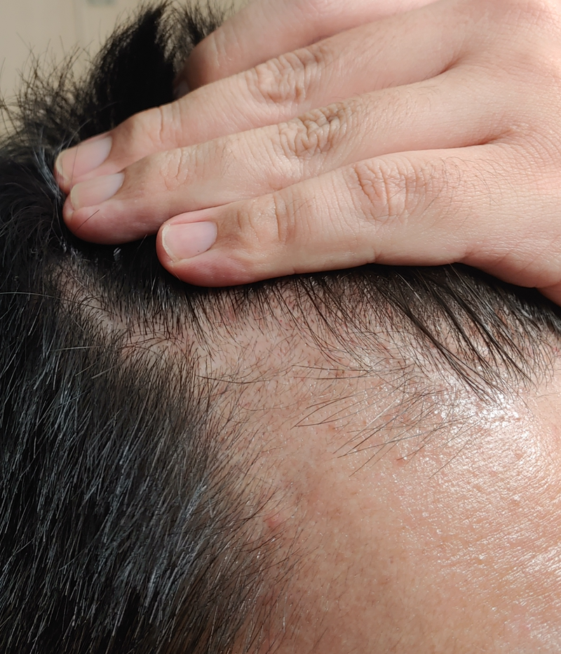 ブラックフォーレ フローズンスケーラー、トリートメント 2週目の使用体験談