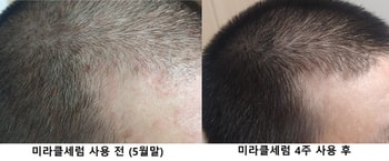 전두부 오른쪽 사용 전후 비교사진
