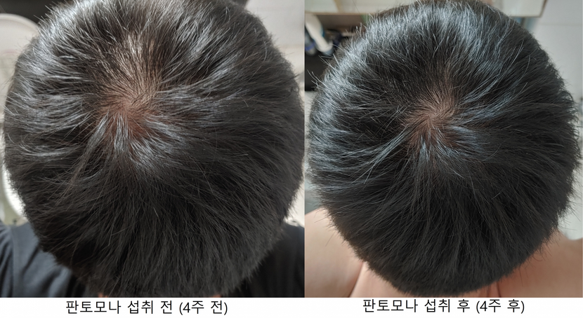 뒤쪽 정수리 비교사진