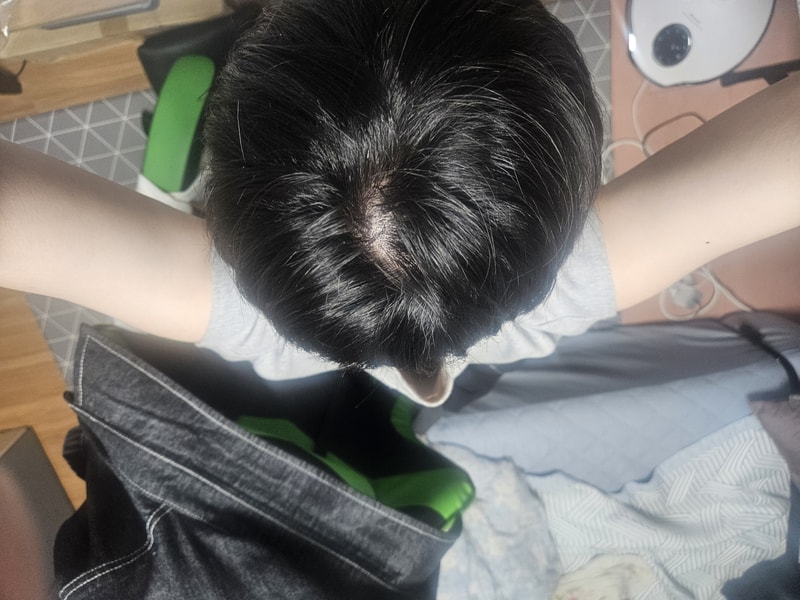 [닥터포헤어] 닥터포헤어 피토테라피 스칼프 에센스 이지스왑 2주차 후기