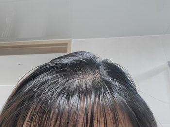 머리카락도 잘 빠지고 유분기가 넘치는 두피와 모발 상태입니다.