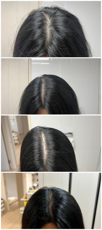 1-4주 비교사진