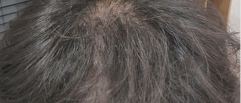 정수리 치료 전 정수리 사진
