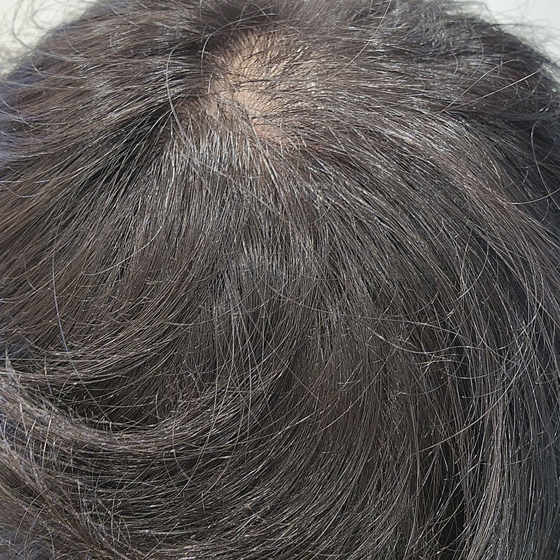 毛髪移植5週目のメディヘアを使用しています！！ (16/24)