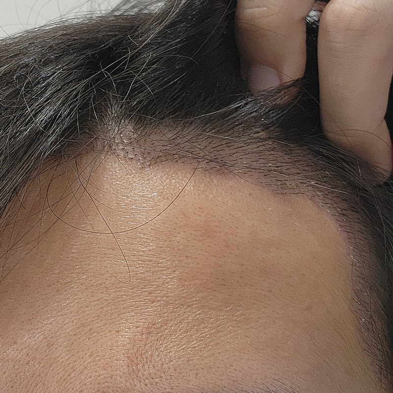 M자 이식 2주후 메디헤어 사용 가능 하다고 하네요 ㅠㅠ (13/24)