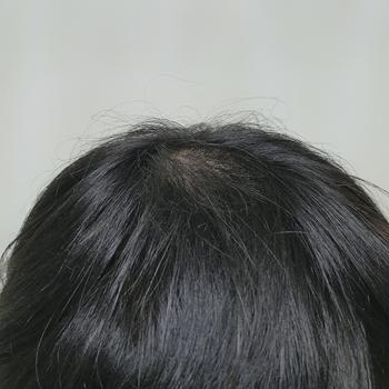 현재 정수리 사진