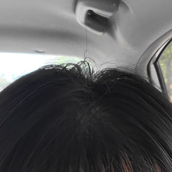 정수리 새로 자란 머리카락들