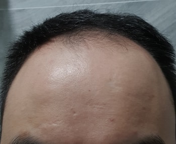 사용 후 이마