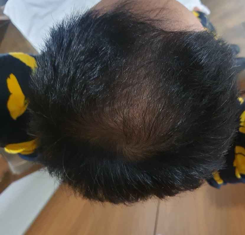 사용 후 정수리
