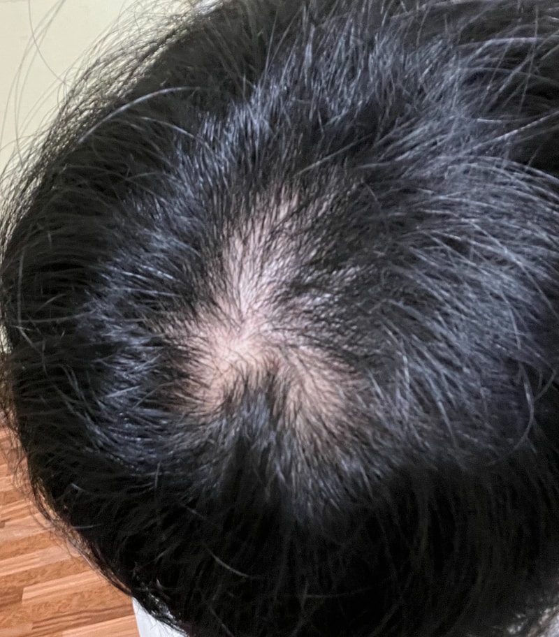 パントモナビオチン4週目服用体験談