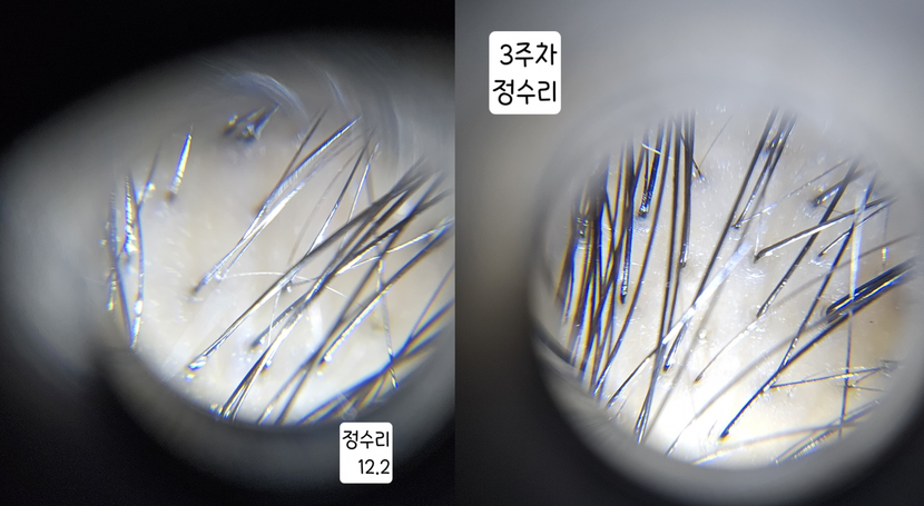 정수리 2주 3주차 비교
