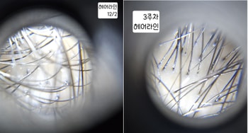 헤어라인 2주 3주차 비교