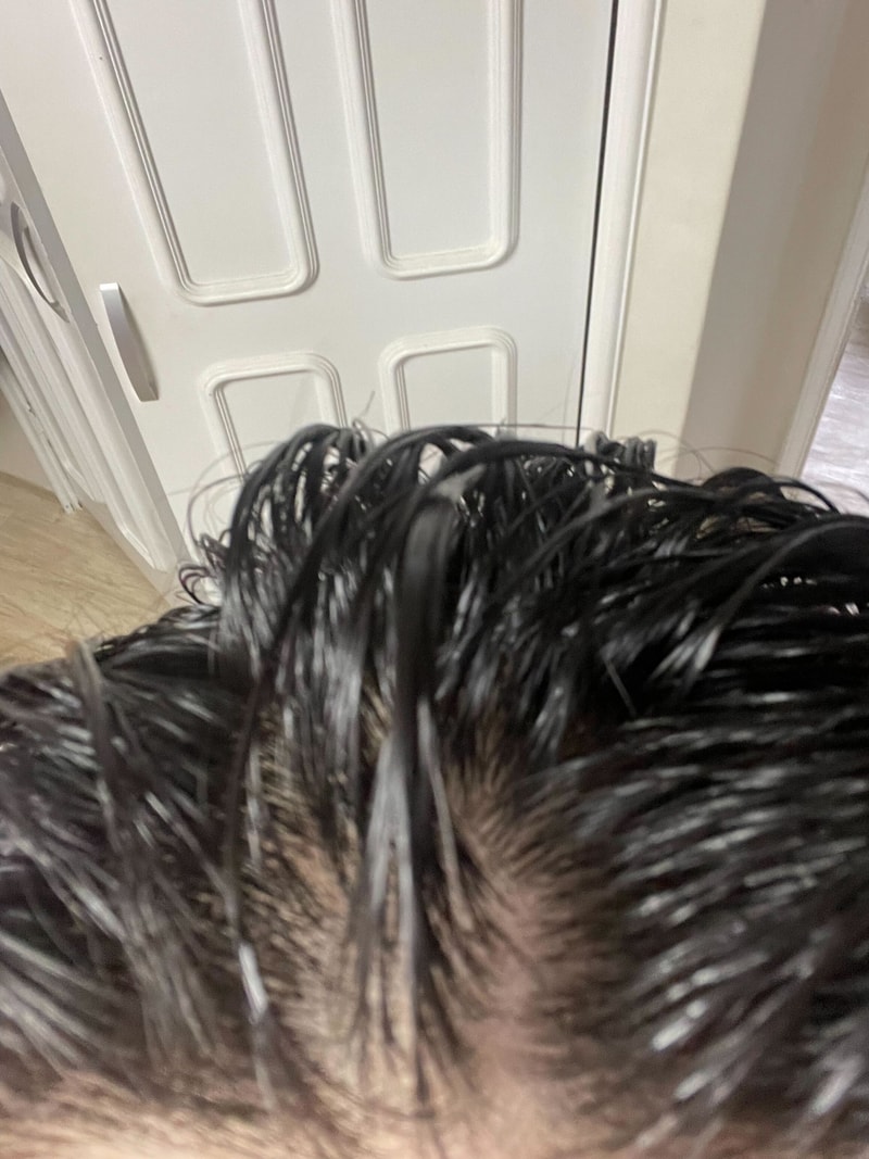 第3週目 - 頭頂部の隙間から生じた産毛