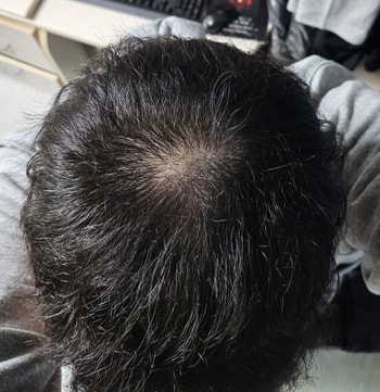 0일차 머리밑 두피상태