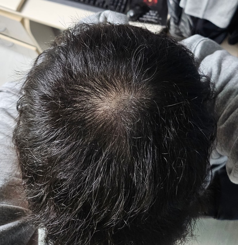 0일차 머리밑 두피상태