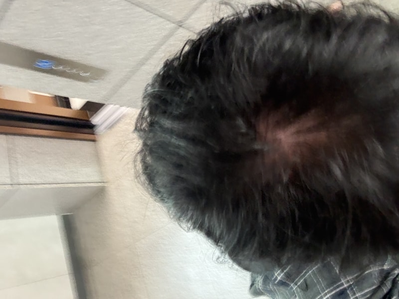 ブラックフォーレ ルートパワーシャンプー 2週目 体験談