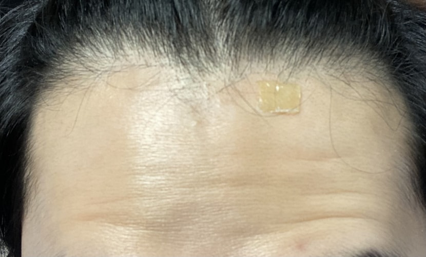 사용후 이마헤어라인 쪽으로 잔머리가 자라기 시작!