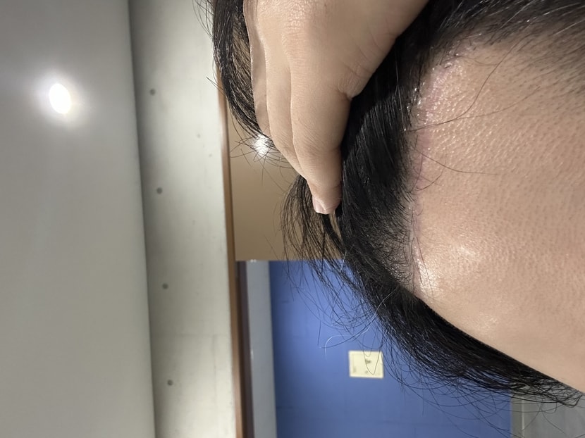 가려움증 완화