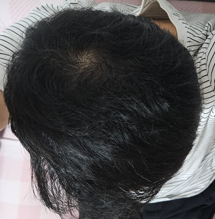 두피사진