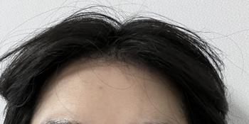 이마라인