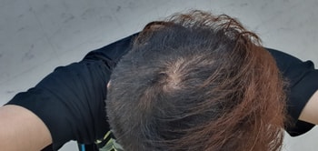 정수리 사진