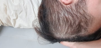 우 측두부